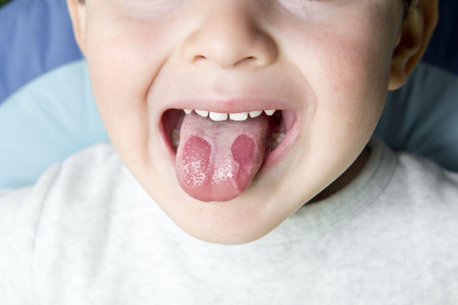 How To Recognize Geographic Tongue In Children Nabta Health