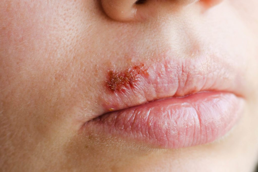 cold-sore-remedies-how-to-treat-and-prevent-cold-sores-on-your-lips