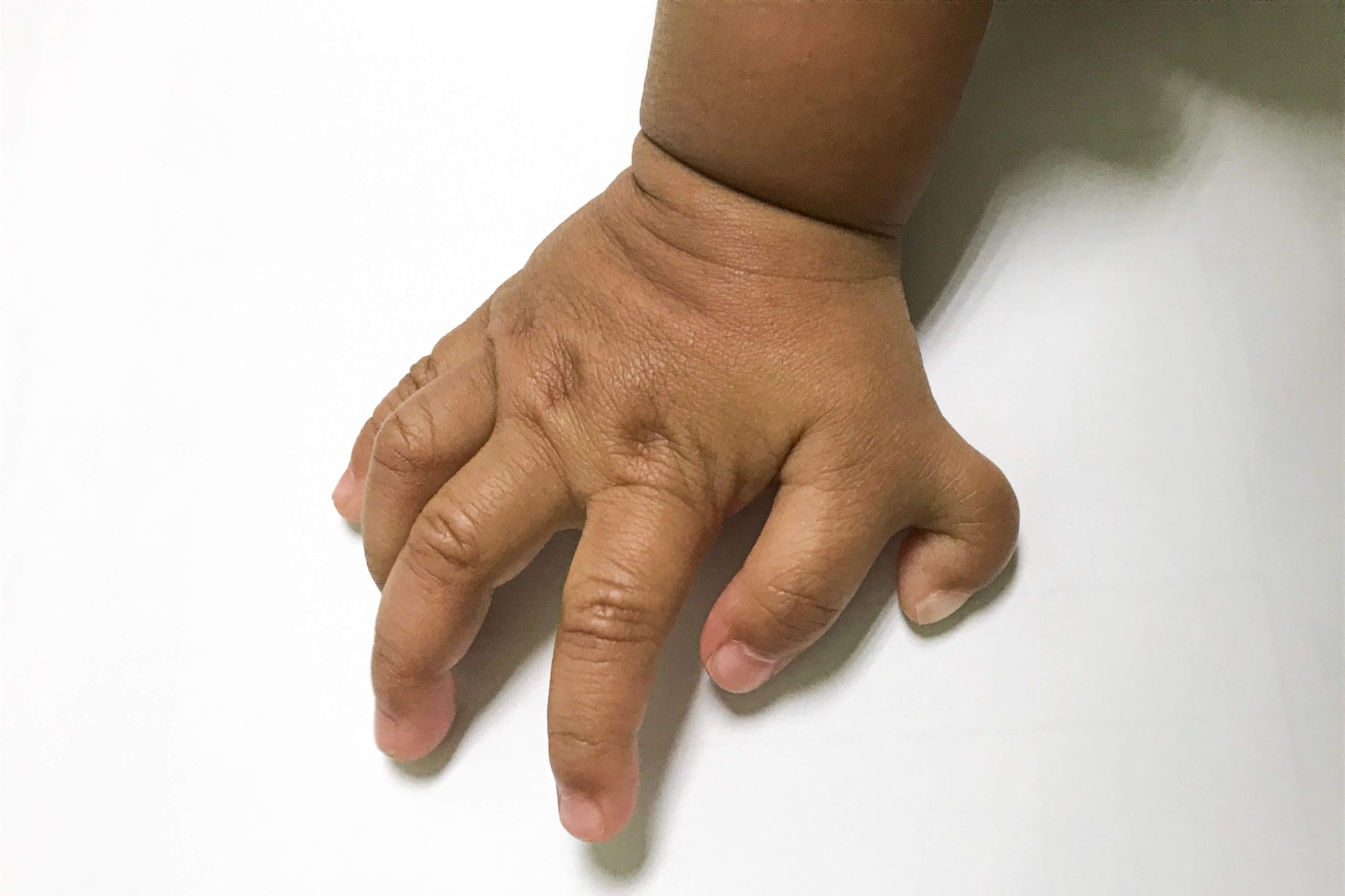 what-you-need-to-know-about-finger-and-toe-deformities-nabta-health