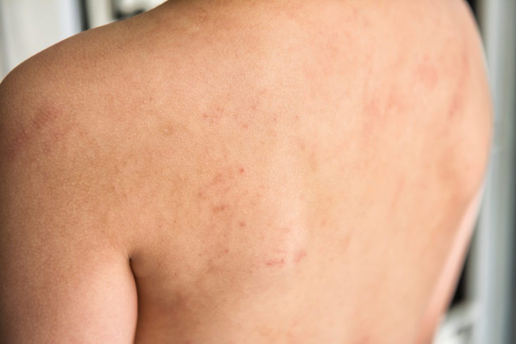 Can Food Allergies Cause Eczema In Adults