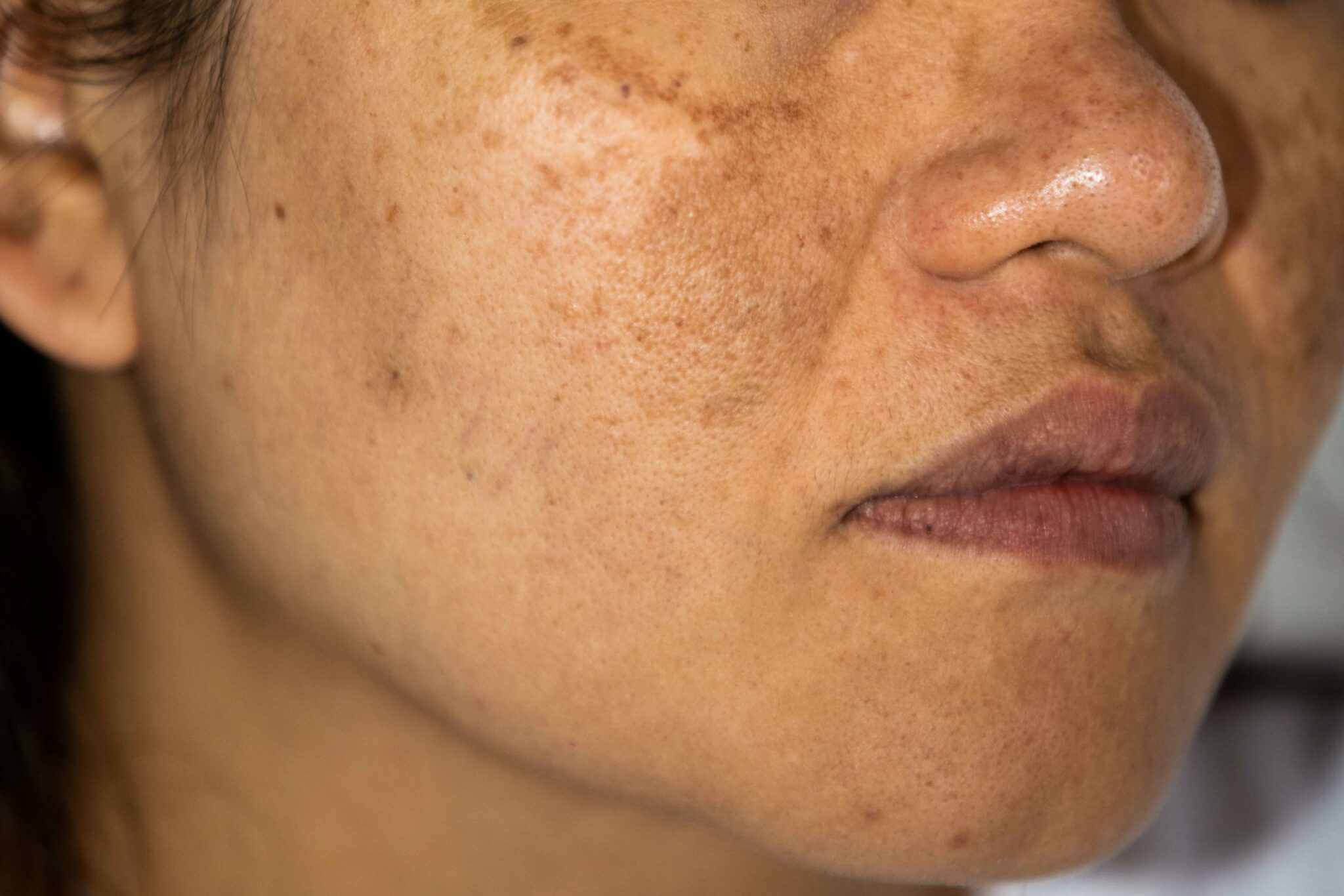 Hyperpigmentation