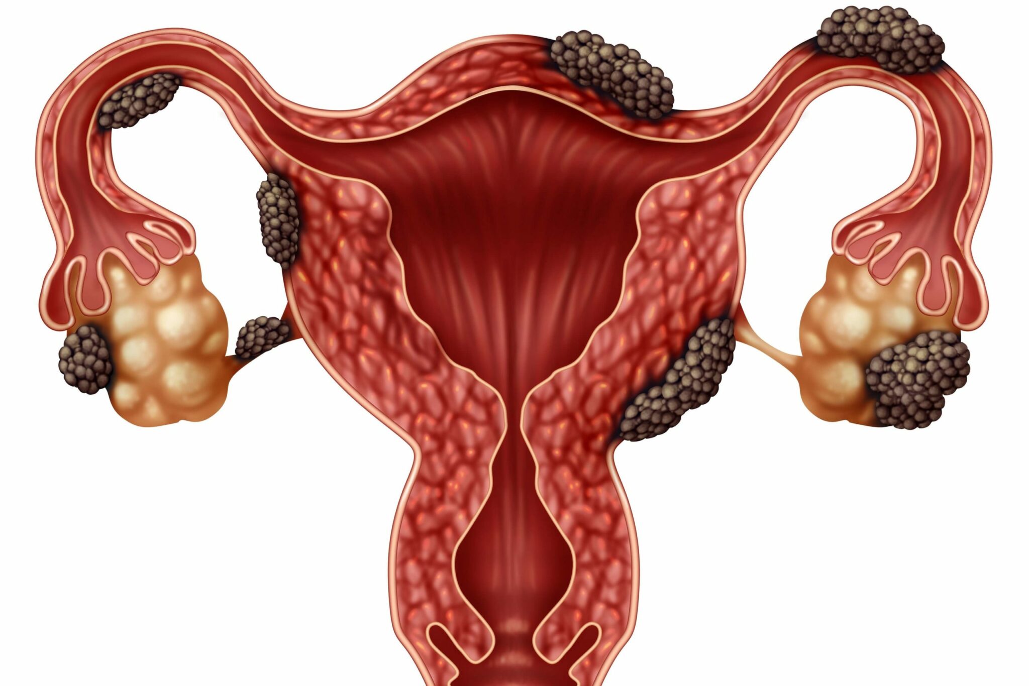 Перитонеальный эндометриоз
