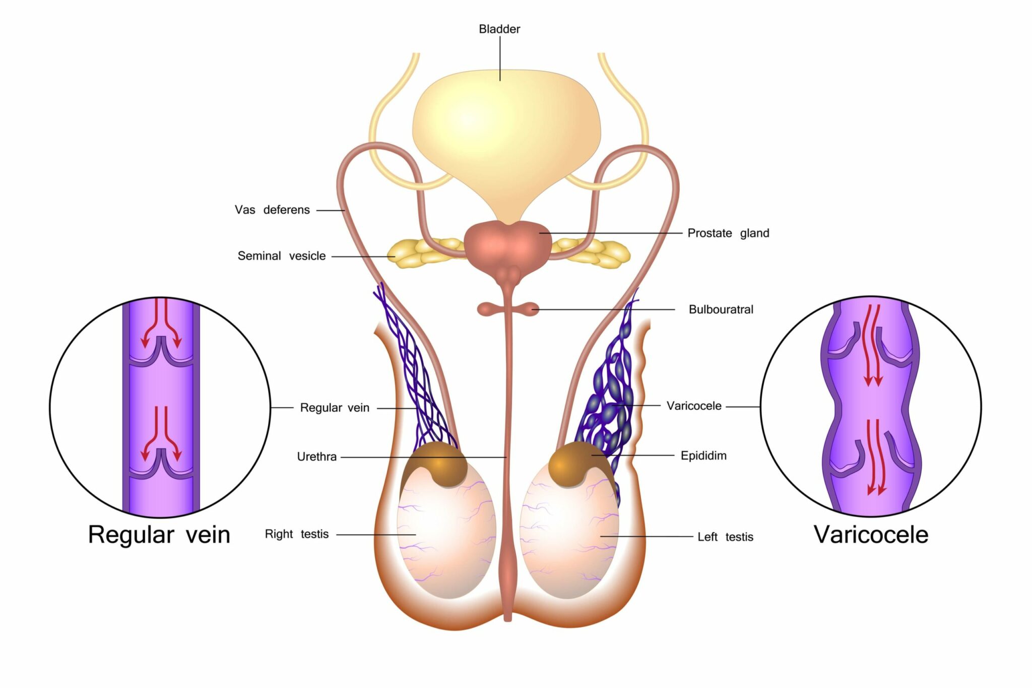 What are Varicoceles  Causes of Varicocele