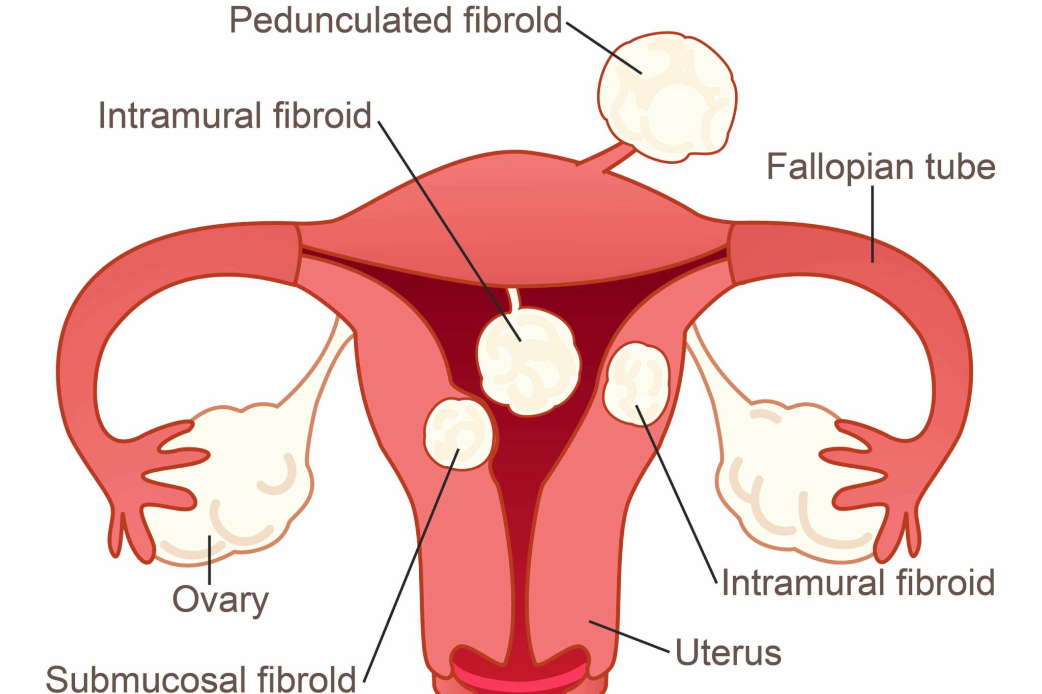 thesis topics on fibroids