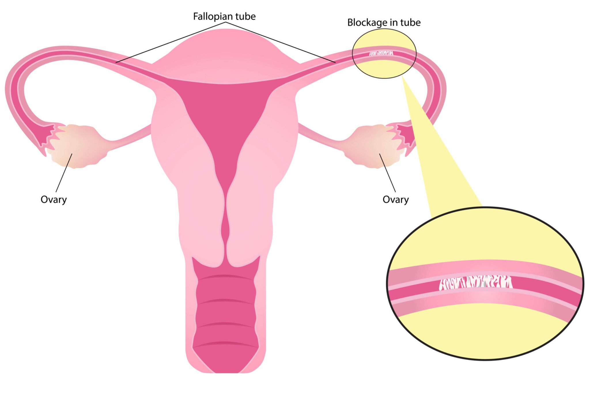 Assessing Fallopian Tube  Patency in Females who are 