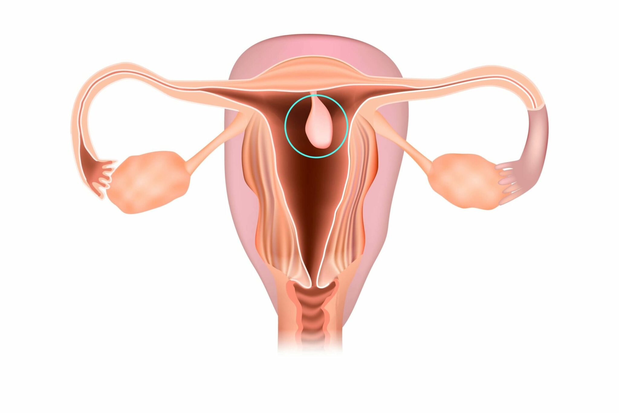 uterine polypse
