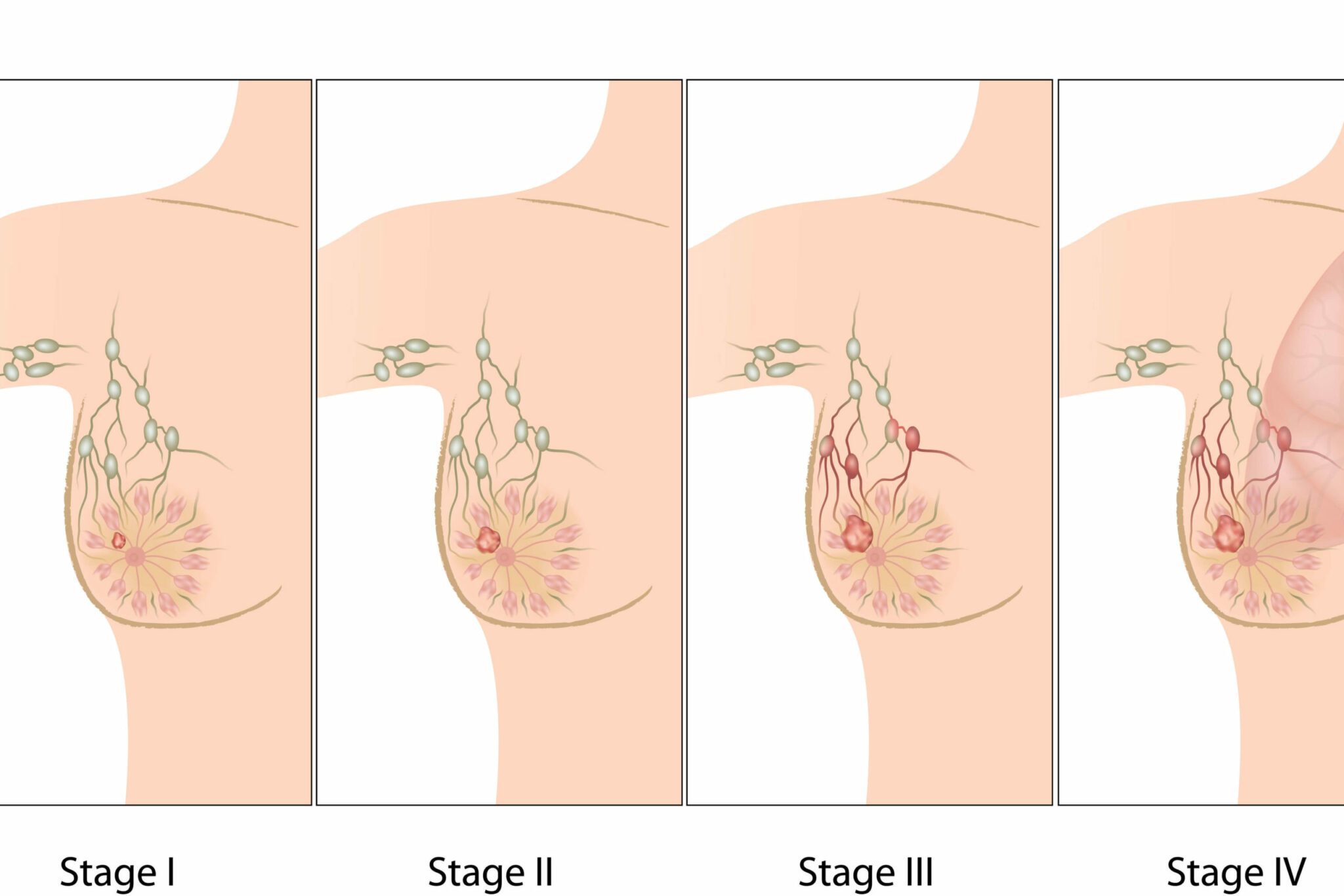 breast cancer staging