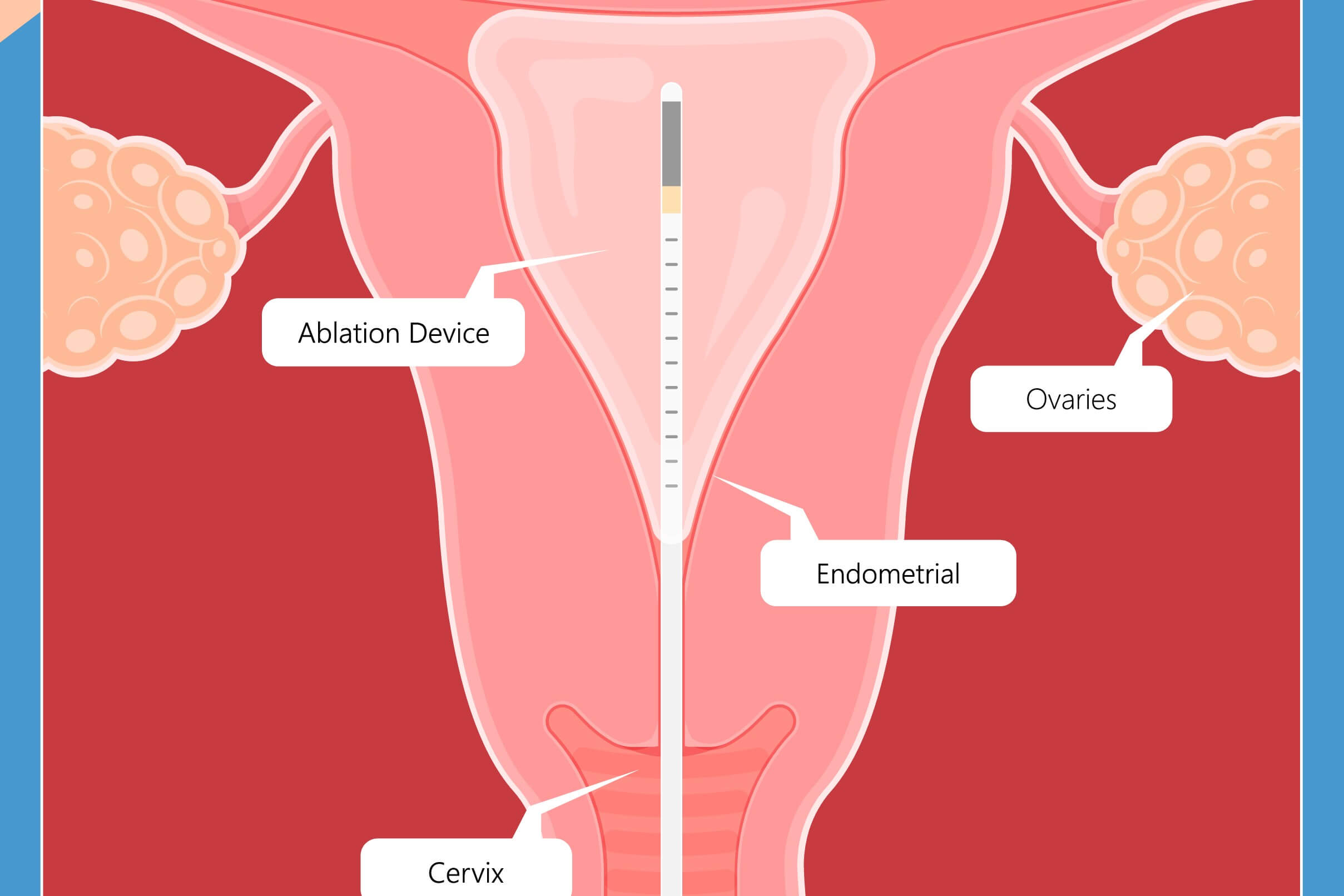 A diagram of a vagina